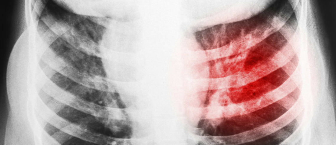 UAE tuberculosis